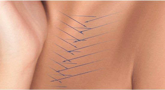 Draadlift PDO behandeling