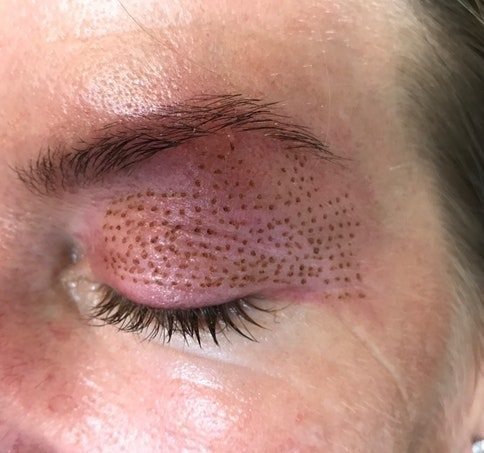 Ooglidverstrakking zonder snijden