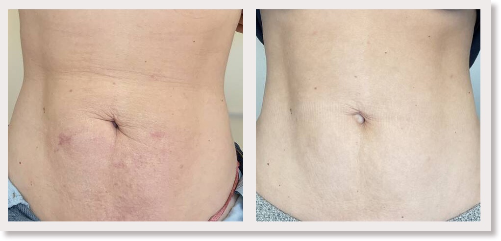 profhilo body voor en na