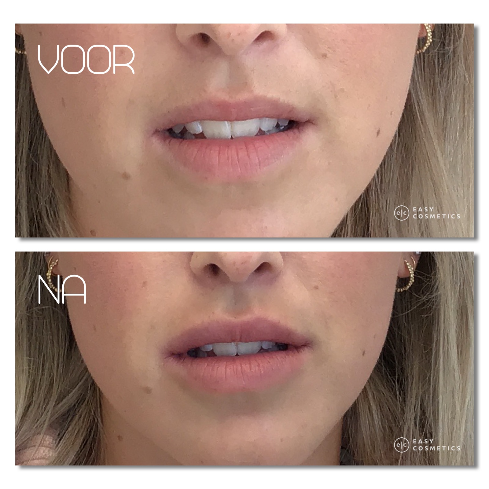 voor na foto lippen