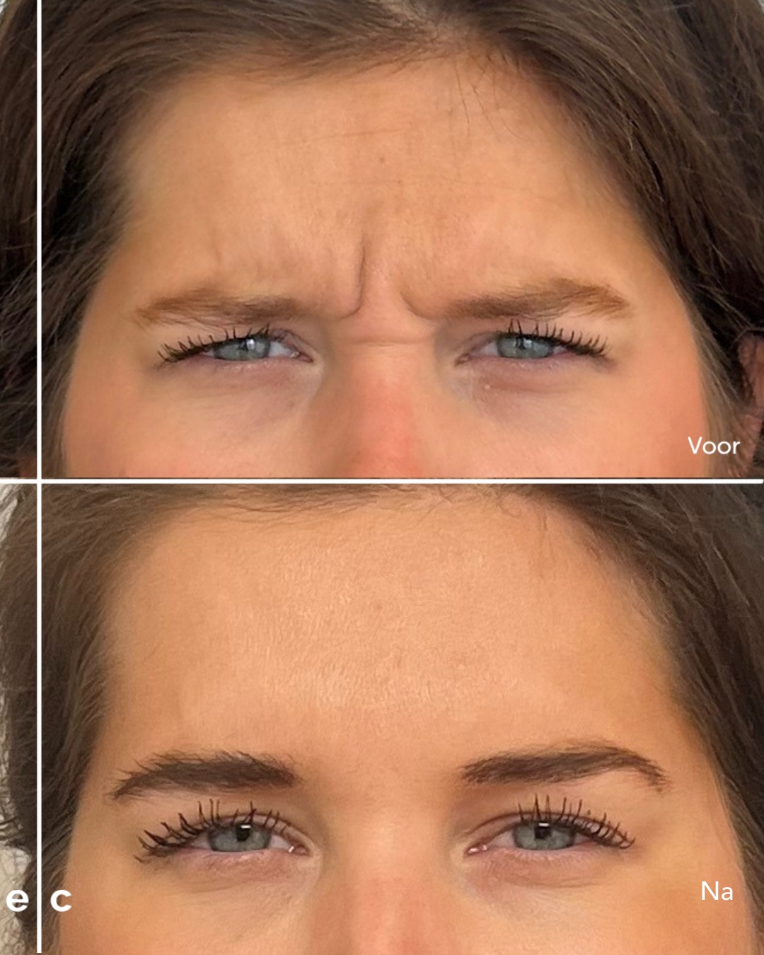 Botox behandeling voor en na